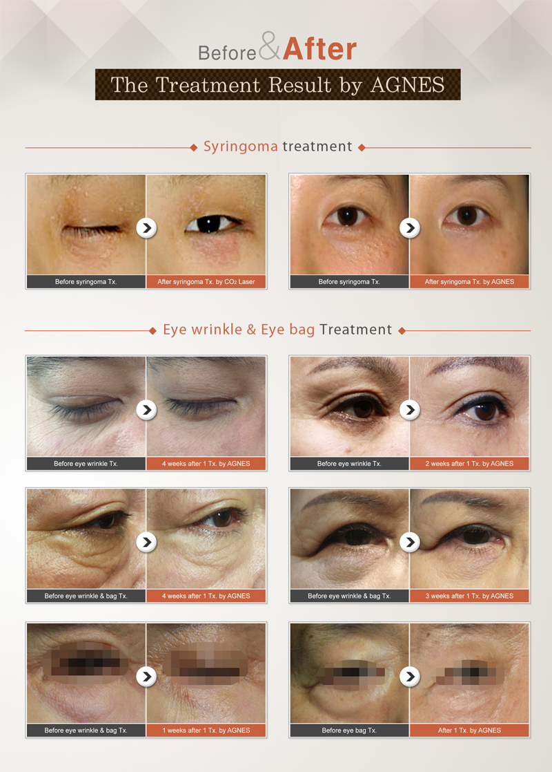 The Treatment Result by AGNES